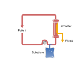 Continuous Veno-Venous Hemofiltration in pre-dilution (Pre-CVVH)