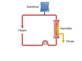 Continuous Veno-Venous Hemofiltration in post-dilution (Post-CVVH)