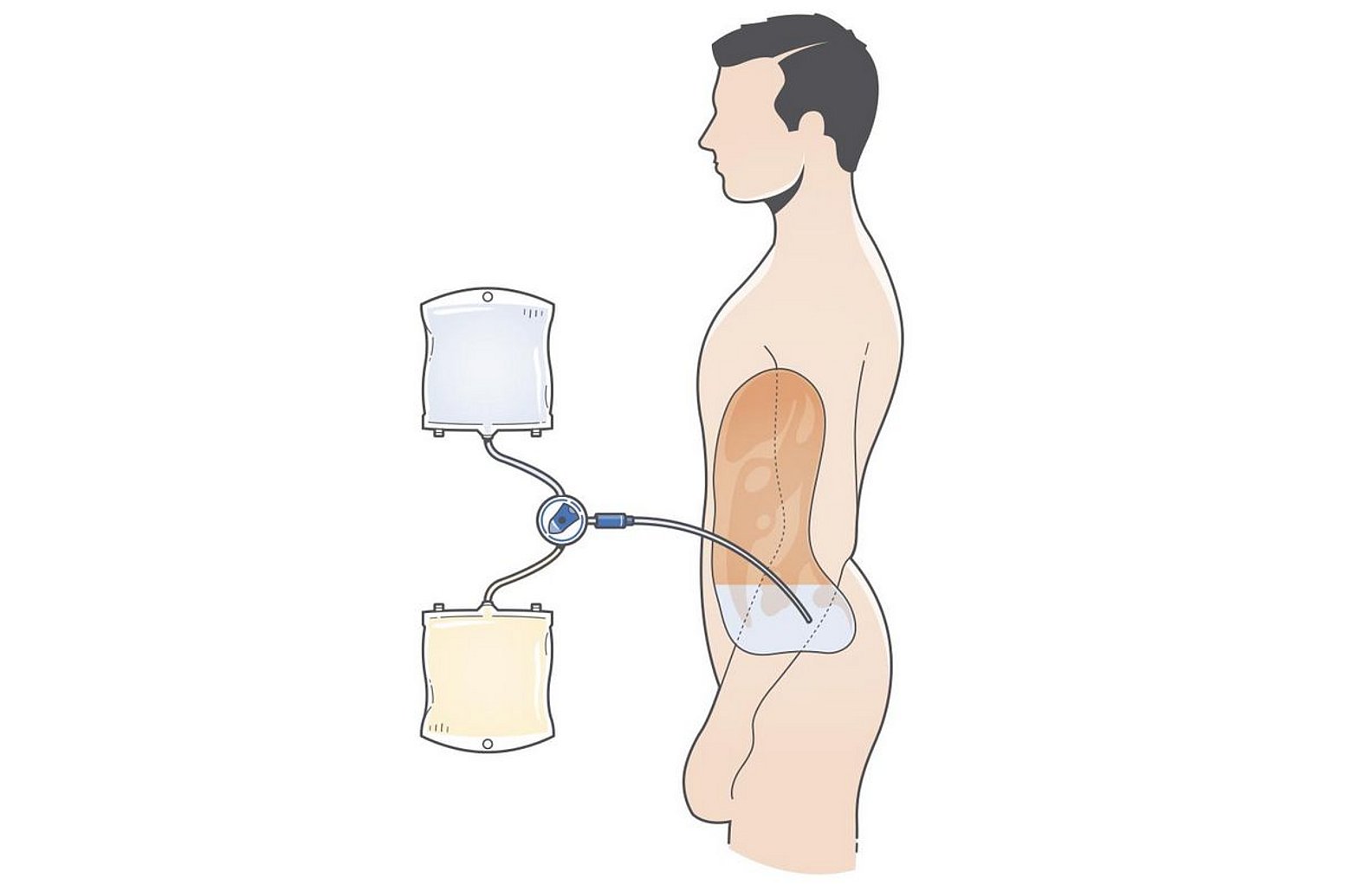 Drawing of peritoneal dialysis treatment