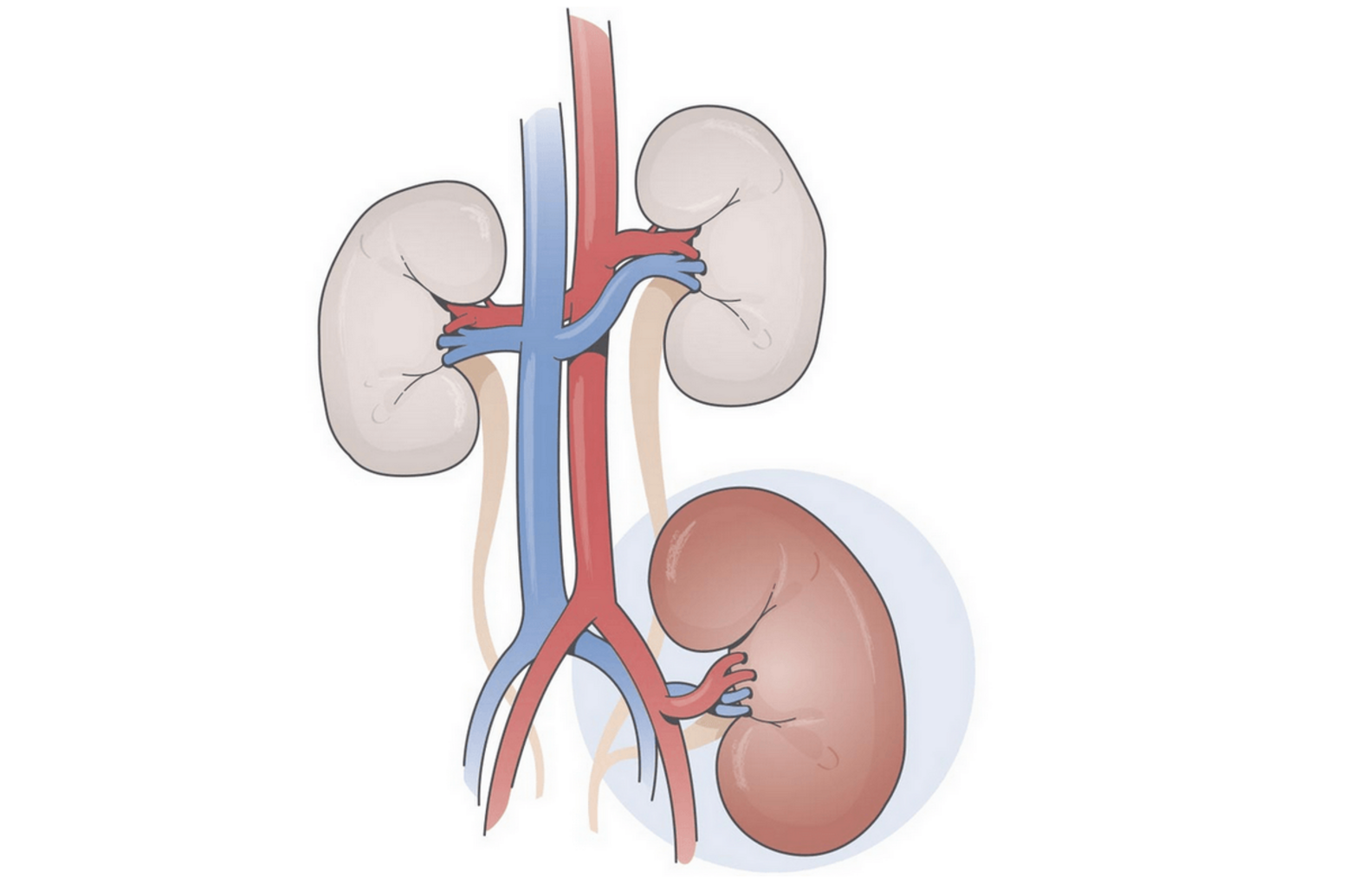 Drawing of a transplanted kidney