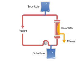 Continuous Veno-Venous Hemofiltration in pre-and postdilution (Pre-Post CVVH)