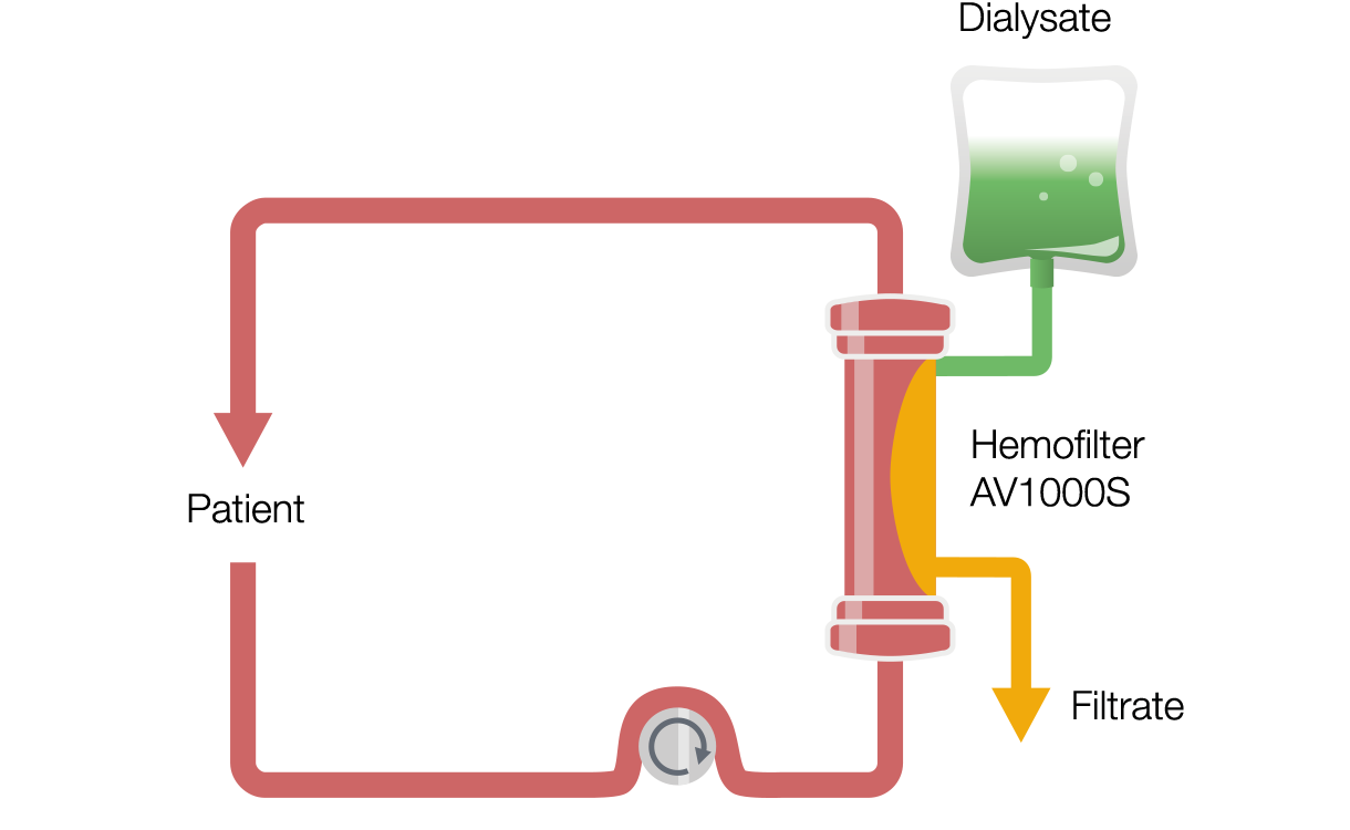 Continuous Veno-Venous Hemodialysis (CVVHD)