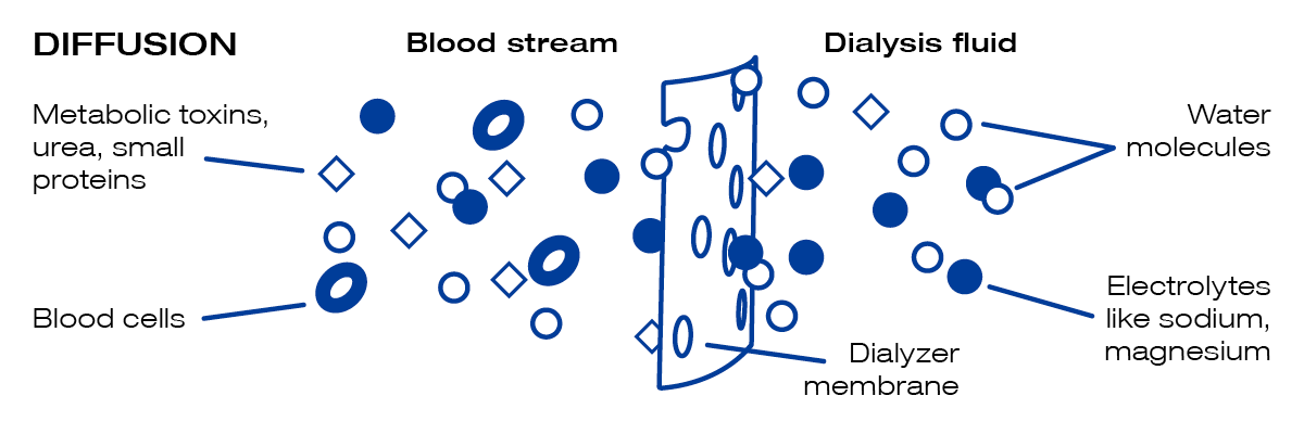 understanding-dialysis-fresenius-medical-care